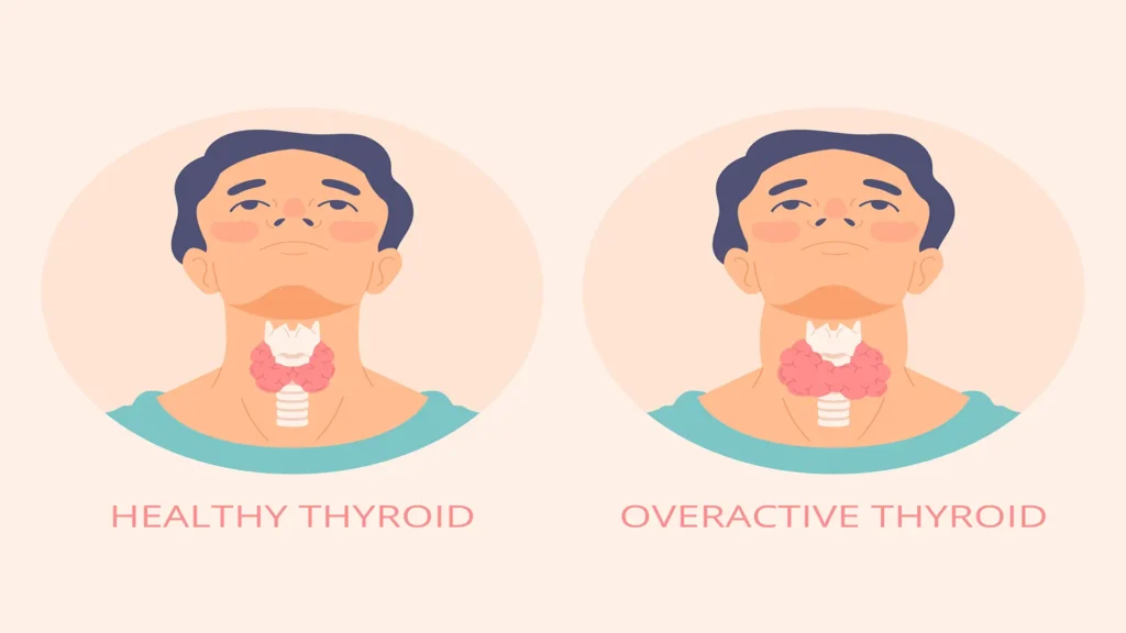 Thyroid diseases