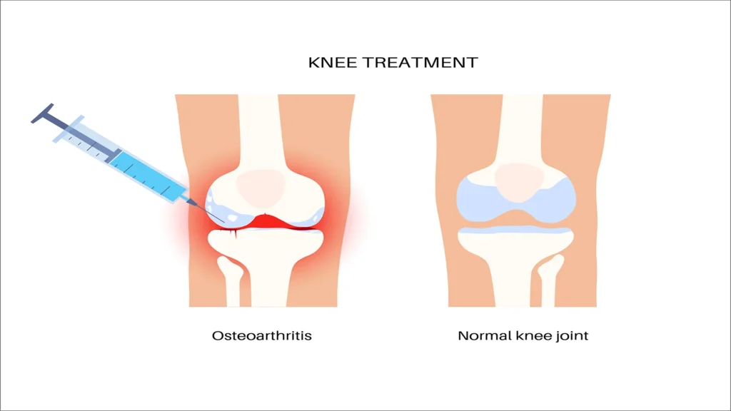 Arthritis Template prp