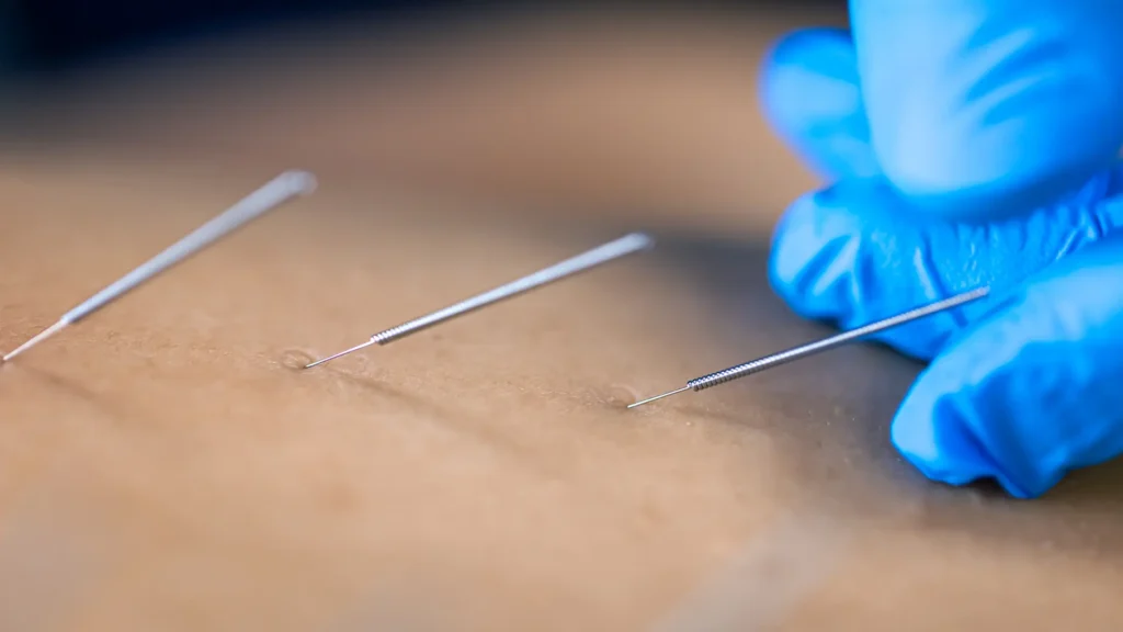 close up needle hands physiotherapist doing dry needling